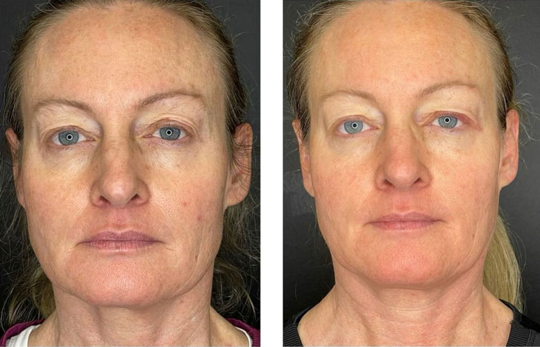 before and after female patient face front view kallos medical aesthetics